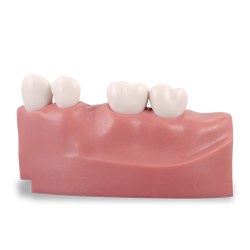 MP OS3 (Pros) Upper Right Mod 02‑06 w/M300 Teeth (Site 4 edentulous)