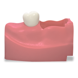 RT OS3 (Endo/Pros) Upper Left Mod 13‑15 w/M300 Teeth